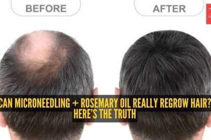 How To Stop Hair Fall: How to reverse hair loss with microneedling and rosemary oil